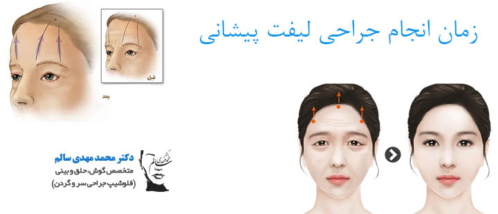 زمان انجام جراحی لیفت پیشانی