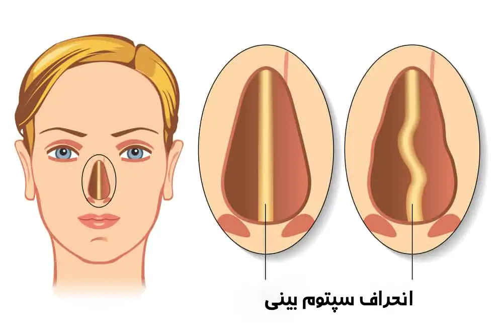عمل انحراف بینی