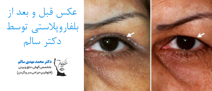 عکس قبل و بعد از بلفاروپلاستی