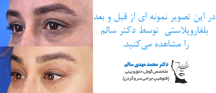 نمونه قبل و بعد از بلفاروپلاستی
