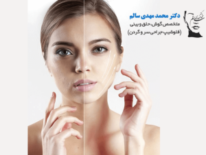 مزایای-لیفت-صورت