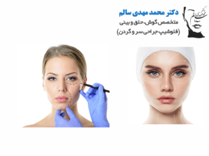 لیفت-صورت-یا-فیلر