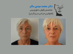 مینی-فیس-لیفت