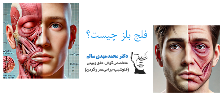 درباره فلج بلز