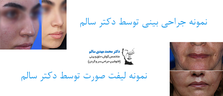 نمونه جراحی بینی و لیفت صورت توسط دکتر سالم