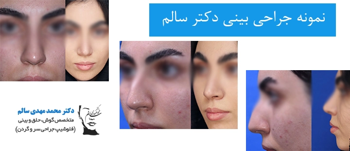 نمونه جراحی بینی دکتر سالم