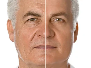 تزریق فیلر قبل از جراحی لیفت صورت