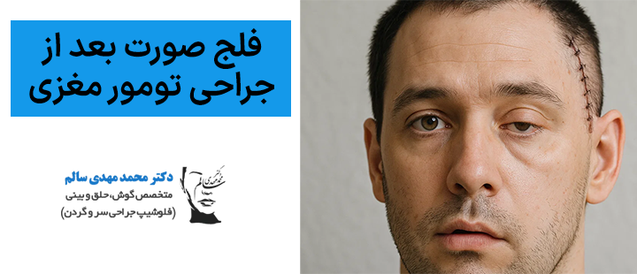 درباره فلج صورت بعد از جراحی تومور مغزی یا گوش
