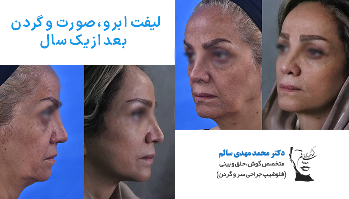 لیفت ابرو صورت گردن بعد از یک سال