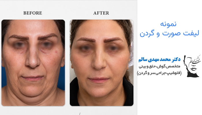 نمونه لیفت صورت و گردن