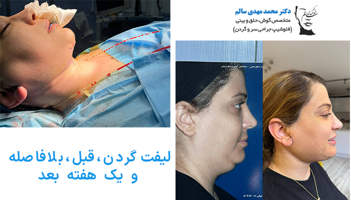 لیفت گردن، قبل، بلافاصله و یک هفته بعد