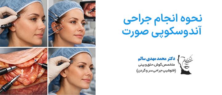نحوه انجام لیفت آندوسکوپی صورت
