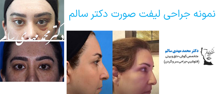 نمونه جراحی لیفت صورت دکتر سالم