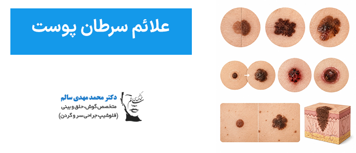 علائم سرطان پوست