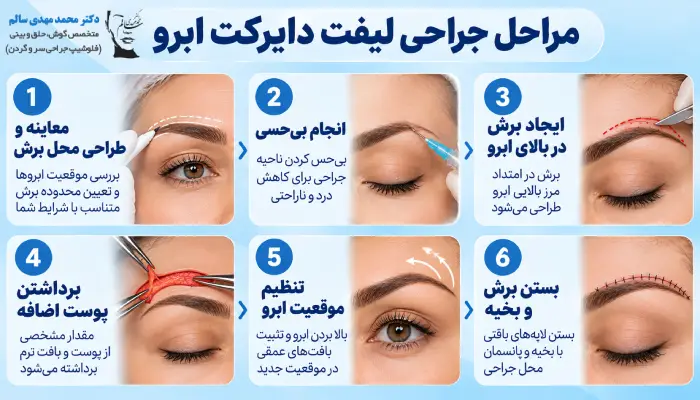 جراحی لیفت دایرکت ابرو چگونه انجام میشود؟