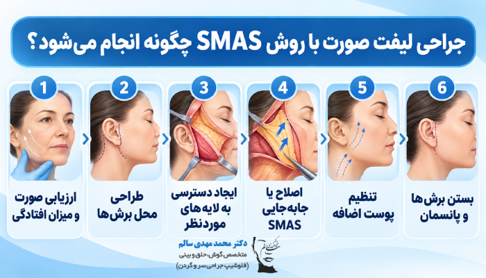 جراحی لیفت صورت با روش SMAS چگونه انجام میشود؟