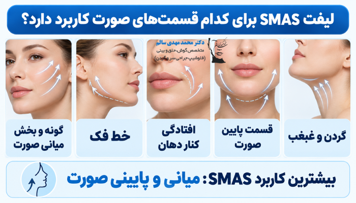 لیفت SMAS برای کدام قسمتهای صورت کاربرد دارد؟